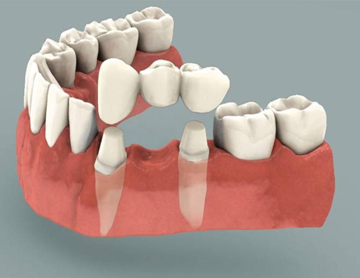 Dental Crowns and Bridges Treatment