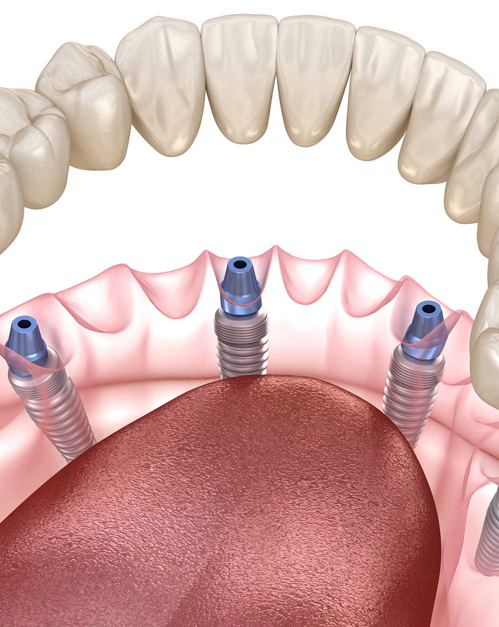 Dental Implants in Borivali